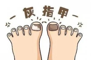 指甲盖凹陷是什么问题