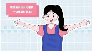 轻度银屑病怎么治疗